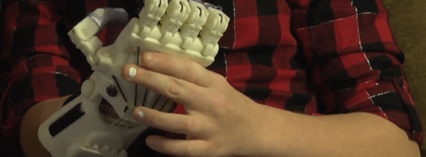 A impressão 3D devolve os dedos que faltam à mão direita desta menina