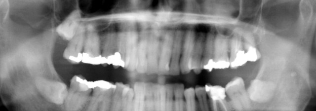 O uso de células-tronco na dentadura pode acabar com as endodontias