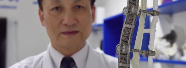 A impressão 3D ajuda a substituir 19 cm de vértebras de um paciente chinês